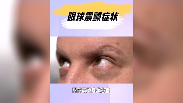 眼球震颤症状