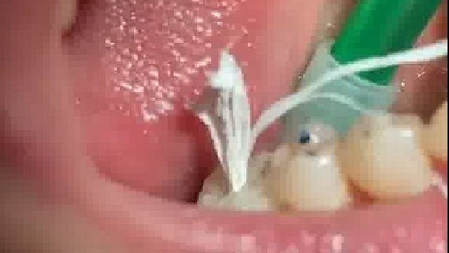 啥条件，牙上都装安全气囊