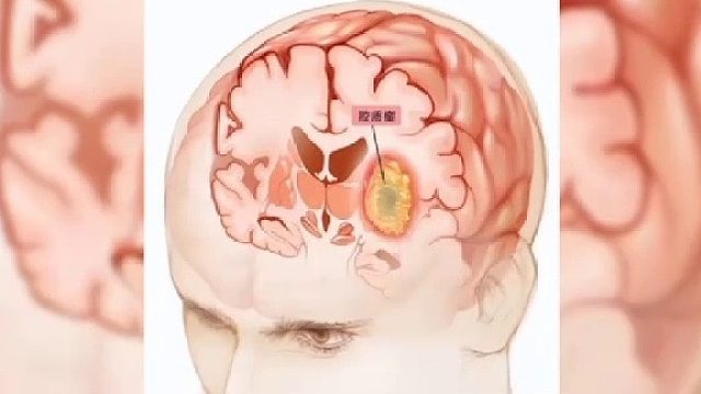 脑鸣神经性疾病
