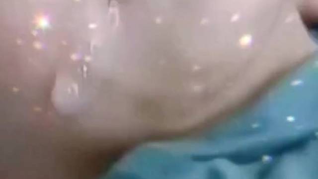 结节性硬化症癫痫发作看着揪心