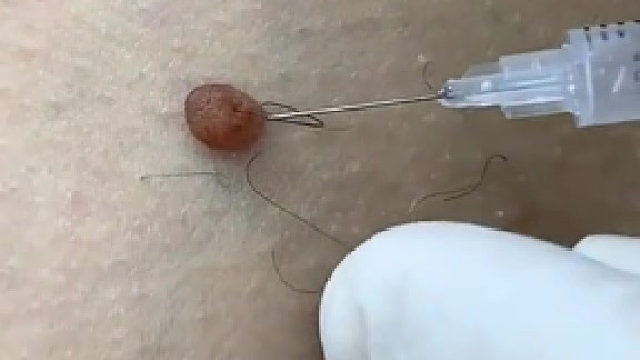 之前我也有个伤口肉球长的比这个还大一点、被我用刮胡刀割了、血止了好几个小时