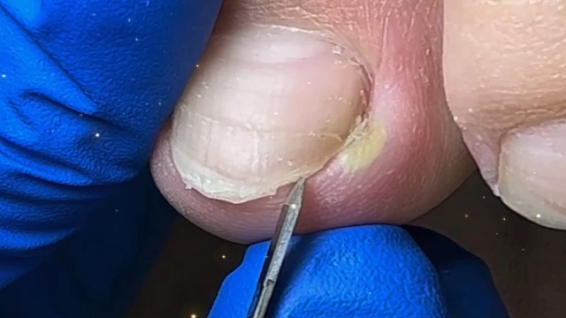 解压甲沟炎爆浆了