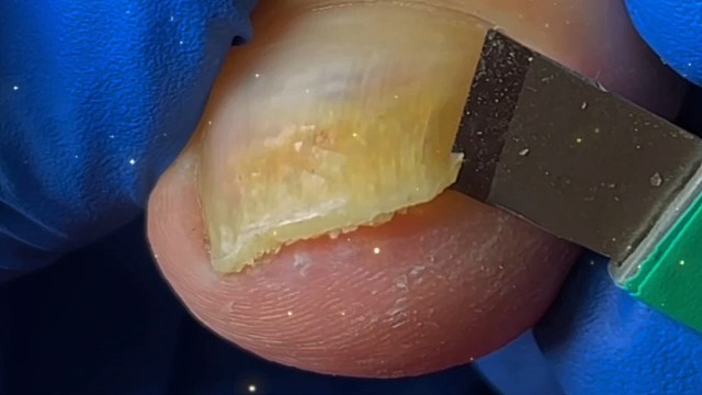 解压灰指甲清理