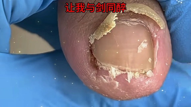 解压修脚甲沟炎藏货十足