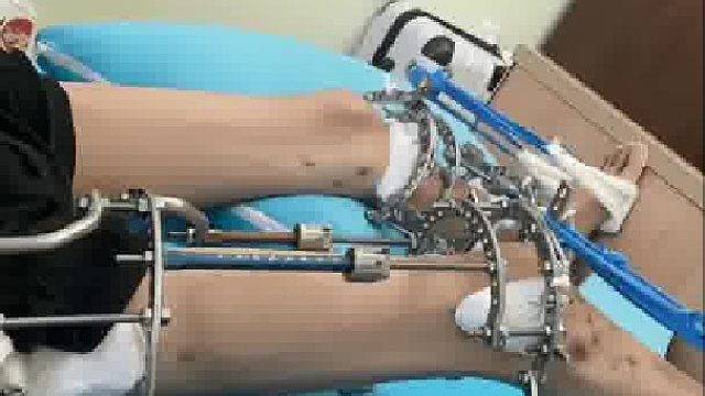 男子花1600万日元整容增高，身高从18暴增到170，宛如重新投胎