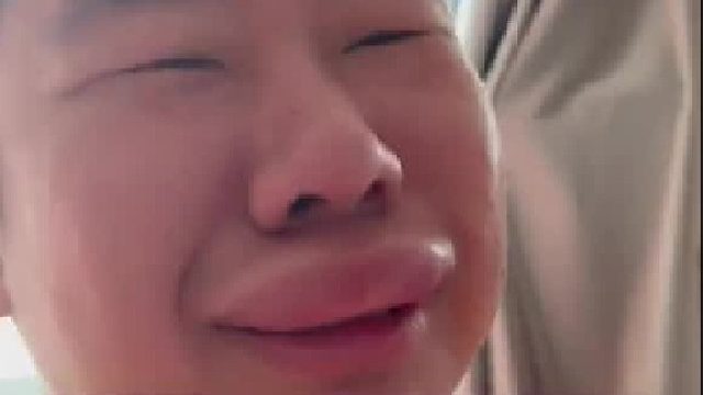 说真的，这蚊子有点东西啊，直接给小伙做了个整形~