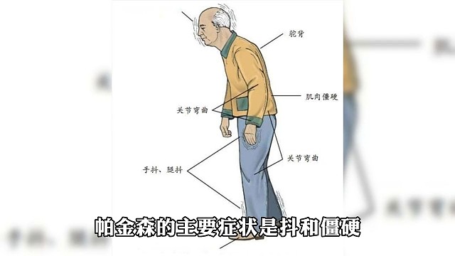 帕金森的主要症状
