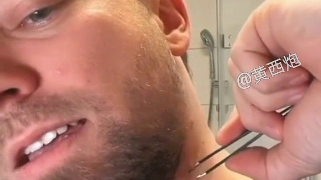 一根超长的、向体内生长的毛发……