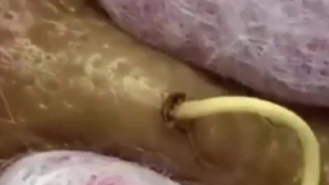 粉瘤，这玩意儿经常长在背上。切了，或者中医外科使用升药外敷