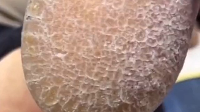 解压强迫症患者