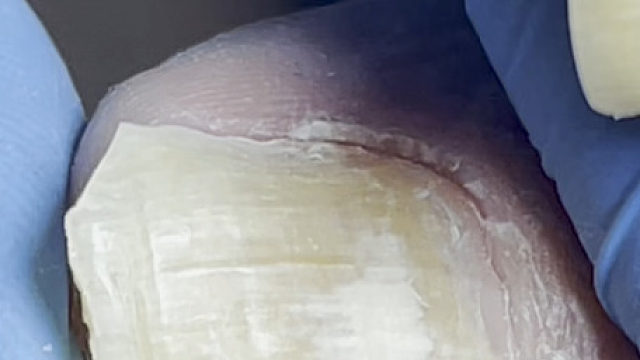 老人的指甲全空了，也不知道多久变成这样了