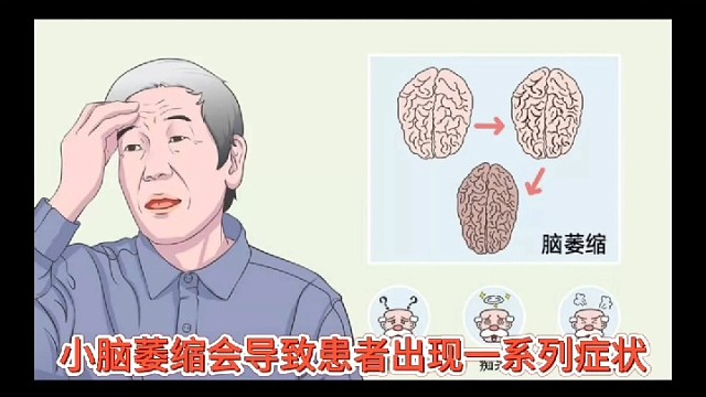 小脑萎缩