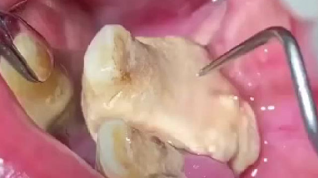 观看洗牙过程可以为人们提供口腔卫生知识。他们可以学到正确的刷牙和牙线使 ​