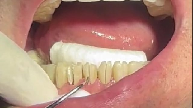 你这是把开心果镶嘴里了？