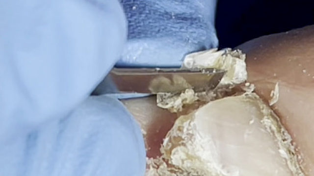 超级厚的指甲，怎么样才能长成这样