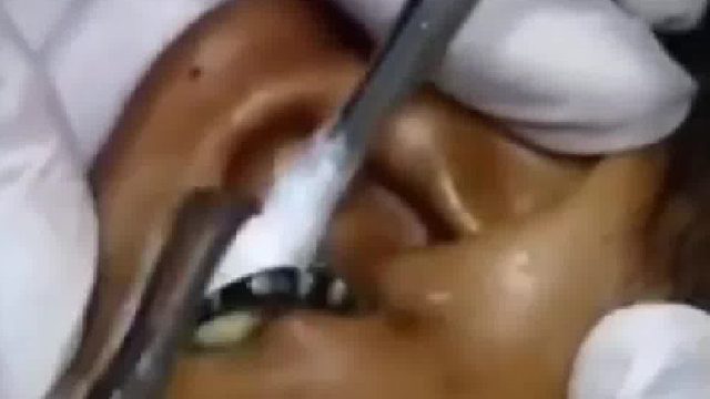 难受，耳朵里有条蛇尾巴躲来躲去