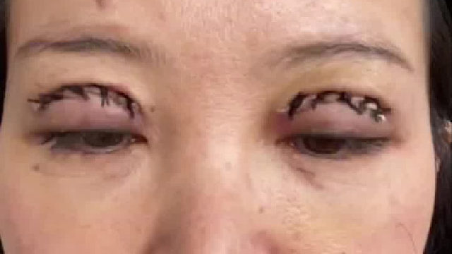 这双眼皮缝的吗？