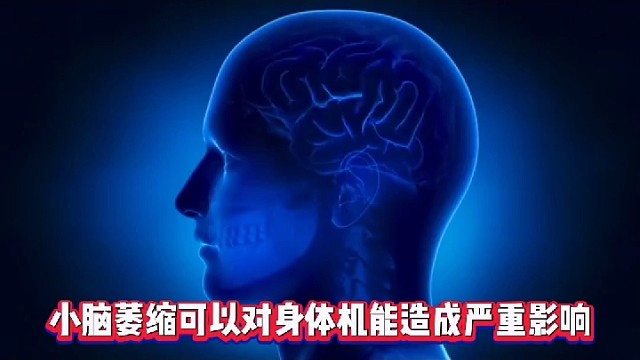 小脑萎缩的危害性