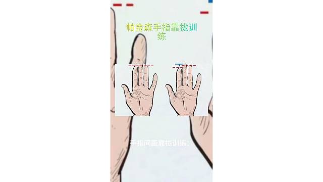 帕金森病人手指的训练