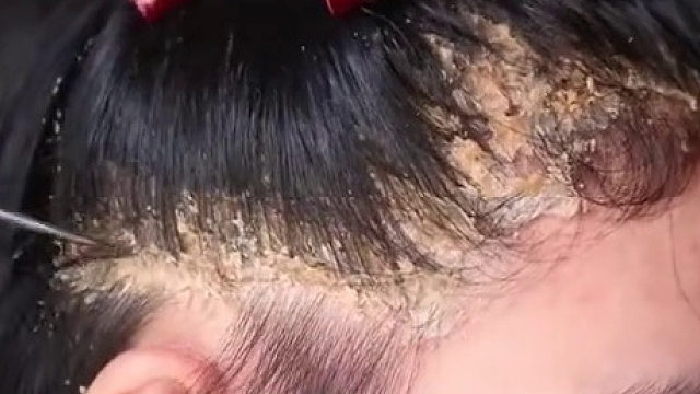 这是掉皮肤碎片吗？