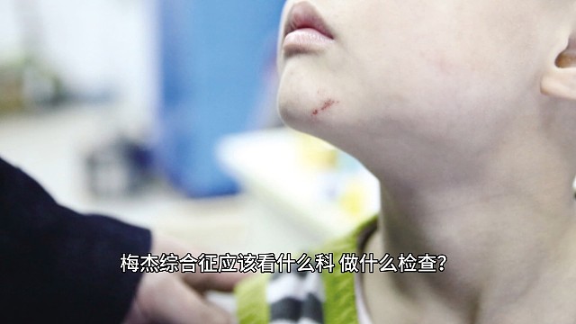 梅杰综合征应该看什么科？做什么检查？