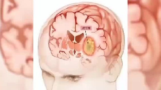 脑鸣、失眠、焦虑该怎么办
