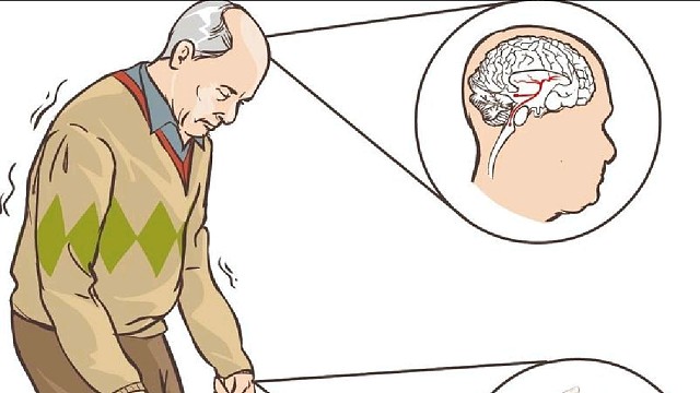 帕金森患者为什么容易摔倒？#帕金森四肢僵硬