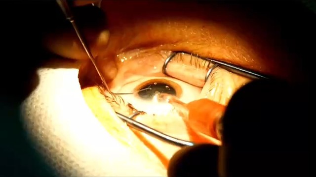 先天性眼球震颤能调理吗？