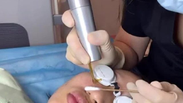 超皮秒治疗q斑反黑几率大吗？