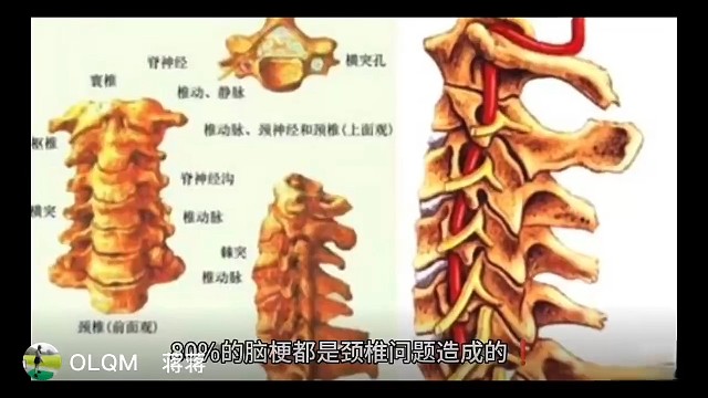 脑梗和颈椎病的关系