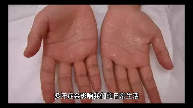 天天出汗影响工作生活