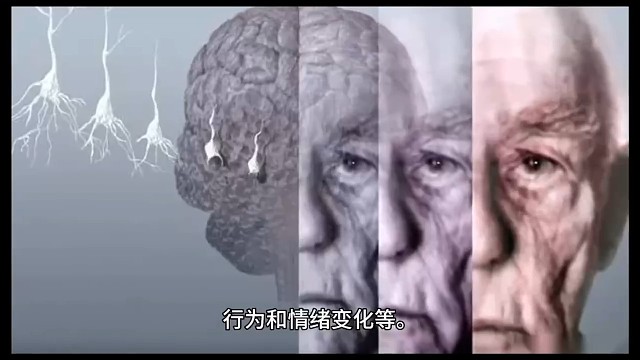 阿尔兹海默症2