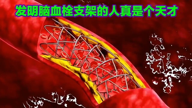 发明脑血栓支架的人真是个天才