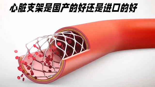心脏支架是国产的好还是进口的好？