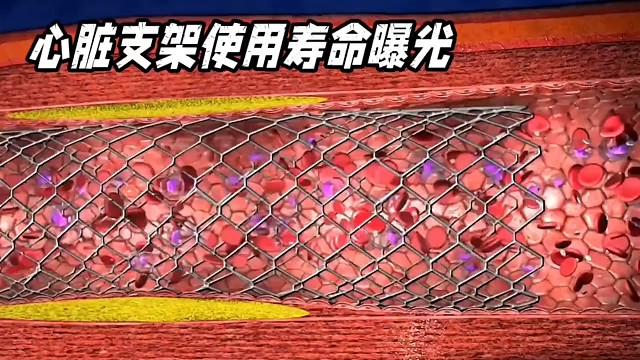 心脏支架使用寿命曝光