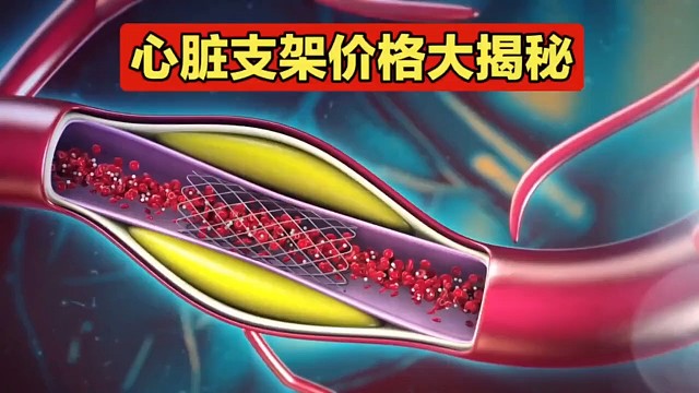 心脏支架价格揭秘