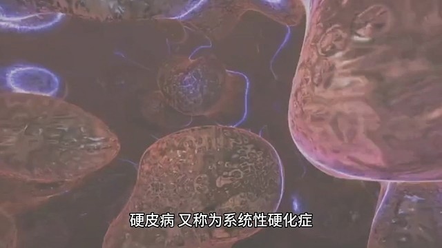 中医对于硬皮病有没有办法？
