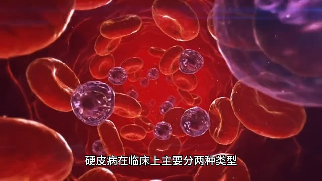 局限性硬皮病有哪些危害