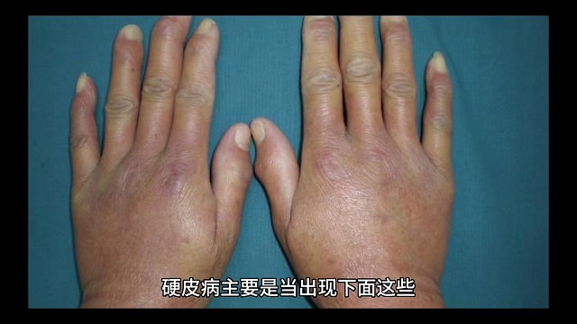 当硬皮病产生哪些症状
才属于晚期