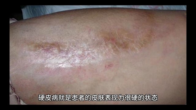 如何分辨自己是局限性还是系统性硬皮病？