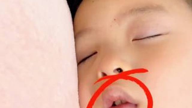 #兒童閉口貼  口呼吸矯正貼兒童睡覺防張嘴防止嘴巴張口封嘴貼閉口貼閉嘴神器#嘴巴閉合矯正貼  #嘴巴