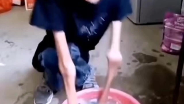漸凍癥癥狀表現(xiàn)
