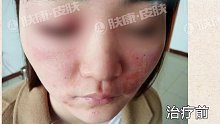 湿疹虽然容易反复发作，但也可以治疗！南京肤康