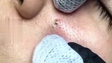 一挤一搓解决黑头