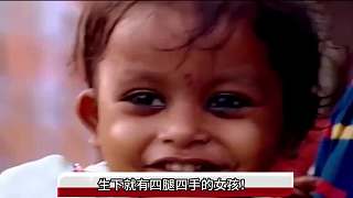 擁有四腿四手的女孩，在別人眼中，被認(rèn)為是天神降世？ 1
