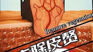 怎樣去除皮贅