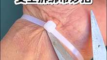 安全拆扎带妙招