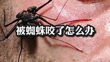 被蜘蛛咬了怎么办