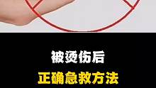 被烫伤后正确急救方法，你知道吗