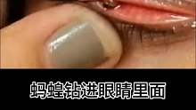 蚂蝗钻进眼睛里面去什么样的体验